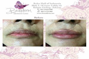 Lips Filler / Filler Bibir